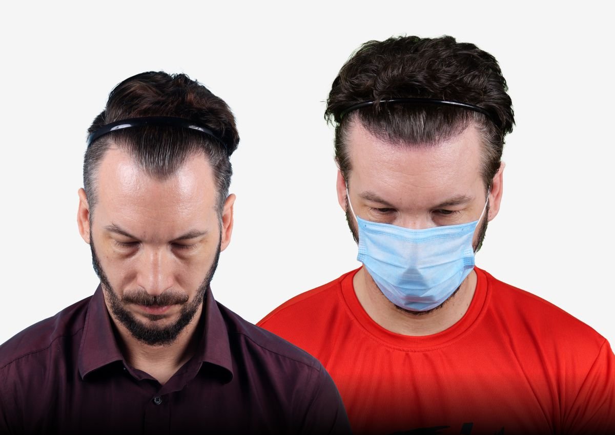 Before and after result - International Hair Transplant