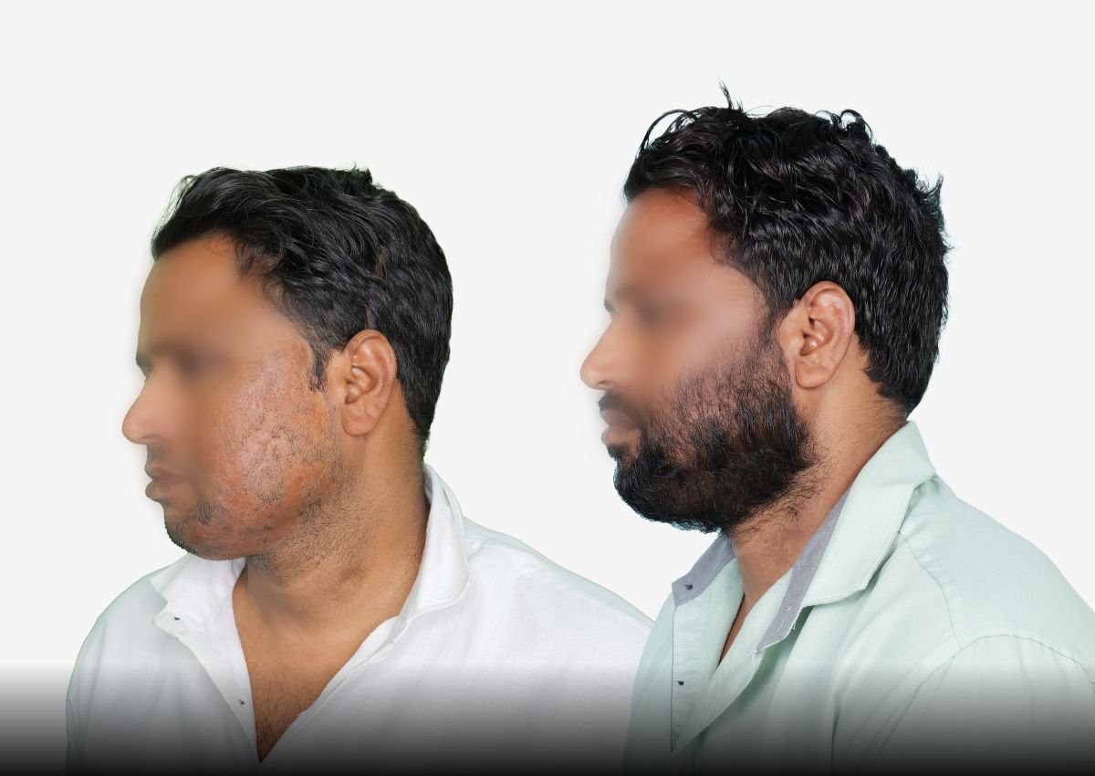 Before and after result - Beard Burn Hair Transplant