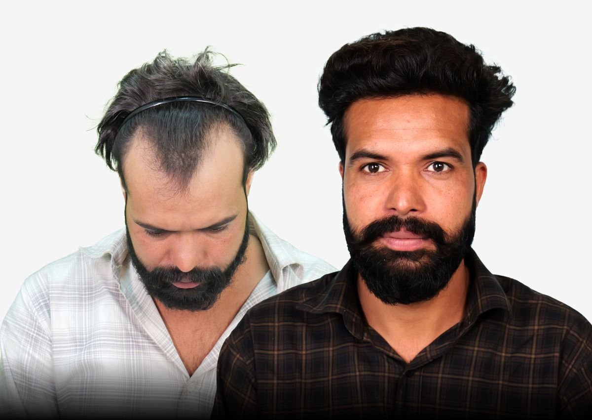 Before and after result - Beard Burn Transplant